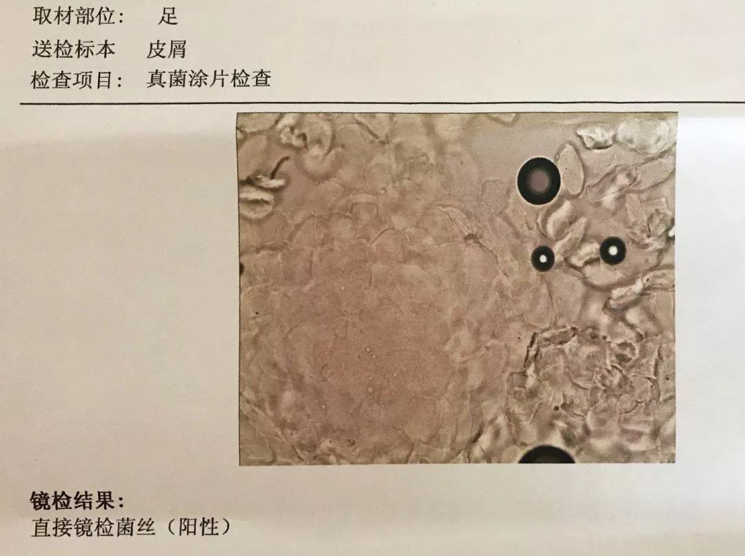 脚丫子足癣,我的脚怎么了