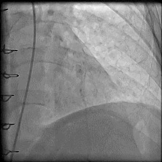 冠脉造影技术成熟不,跟我学技术分析从入门到精通
