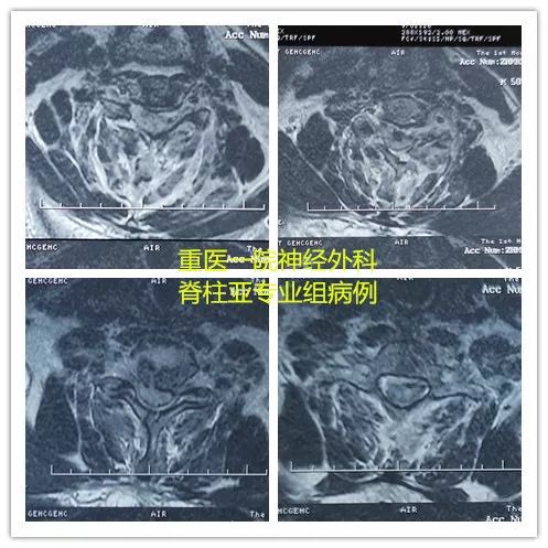 颈椎骨折脱位合并脊髓损伤,颈椎骨折脊髓损伤案例