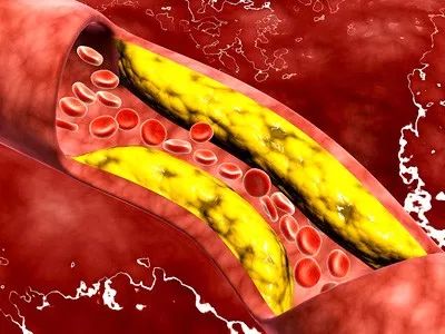 体检发现颈动脉斑块得重视,体检发现颈动脉斑块需要复查吗