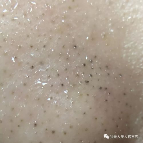 画面极度舒适！十几年顽固老黑头，30秒彻底连根拔起！毛孔畅快呼吸原来是这种感觉