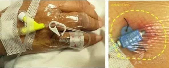 留置针u型敷贴正确撕法,留置针正确固定图片ppt