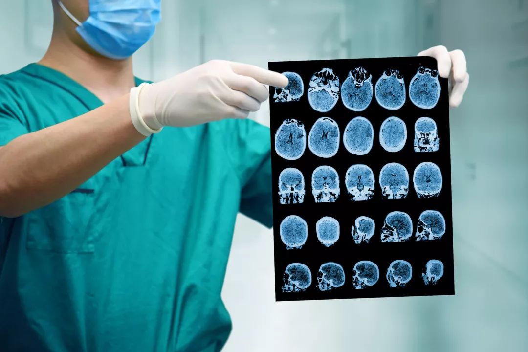 脑卒中最凶险的幕后黑手,血管科普之脑卒中