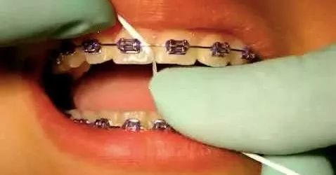 9成中国人没见过，洗牙就用1分钟，美国人用了很久的洁牙神器