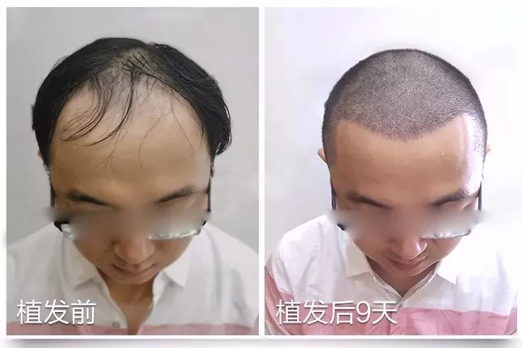 报道来了！28岁小伙“秃”成50岁？过年前抓紧……芜湖全面启动