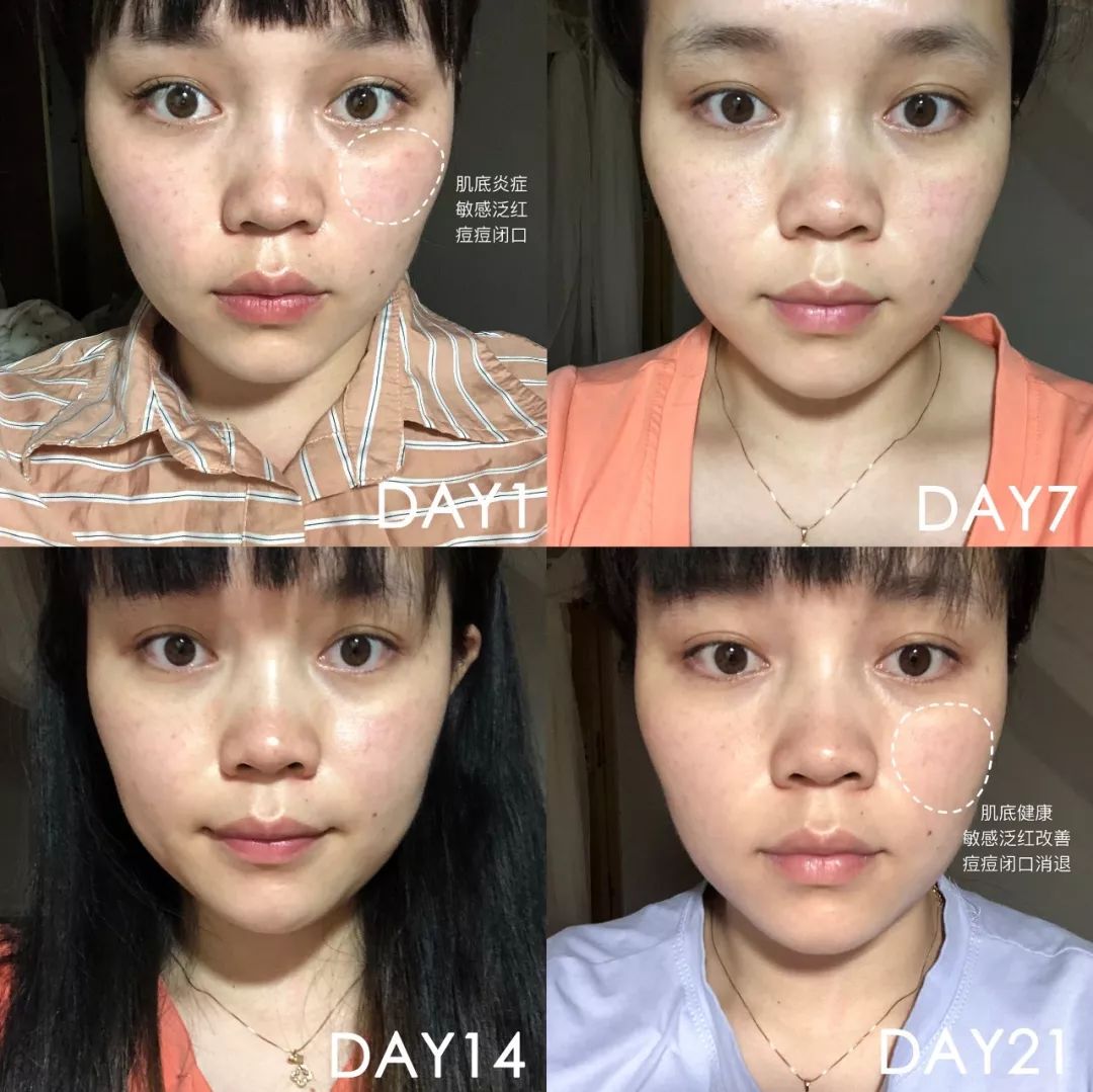 肌诊室修复,肌诊室水光肌挑战