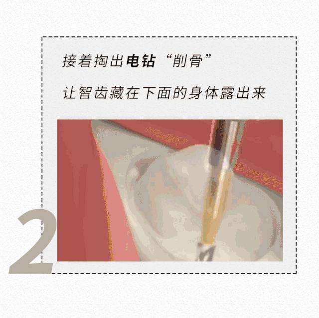 拔智齿的全过程漫画,智齿漫画版