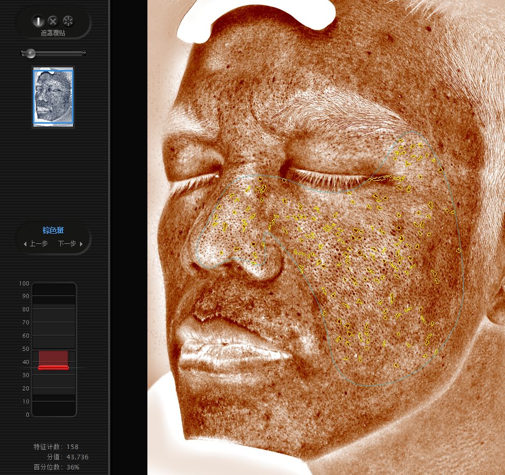 五周年福利｜皮肤“照妖镜”VISIA免费体验！定制你的皮肤管理方案，浙大四院五周年福利持续放送中