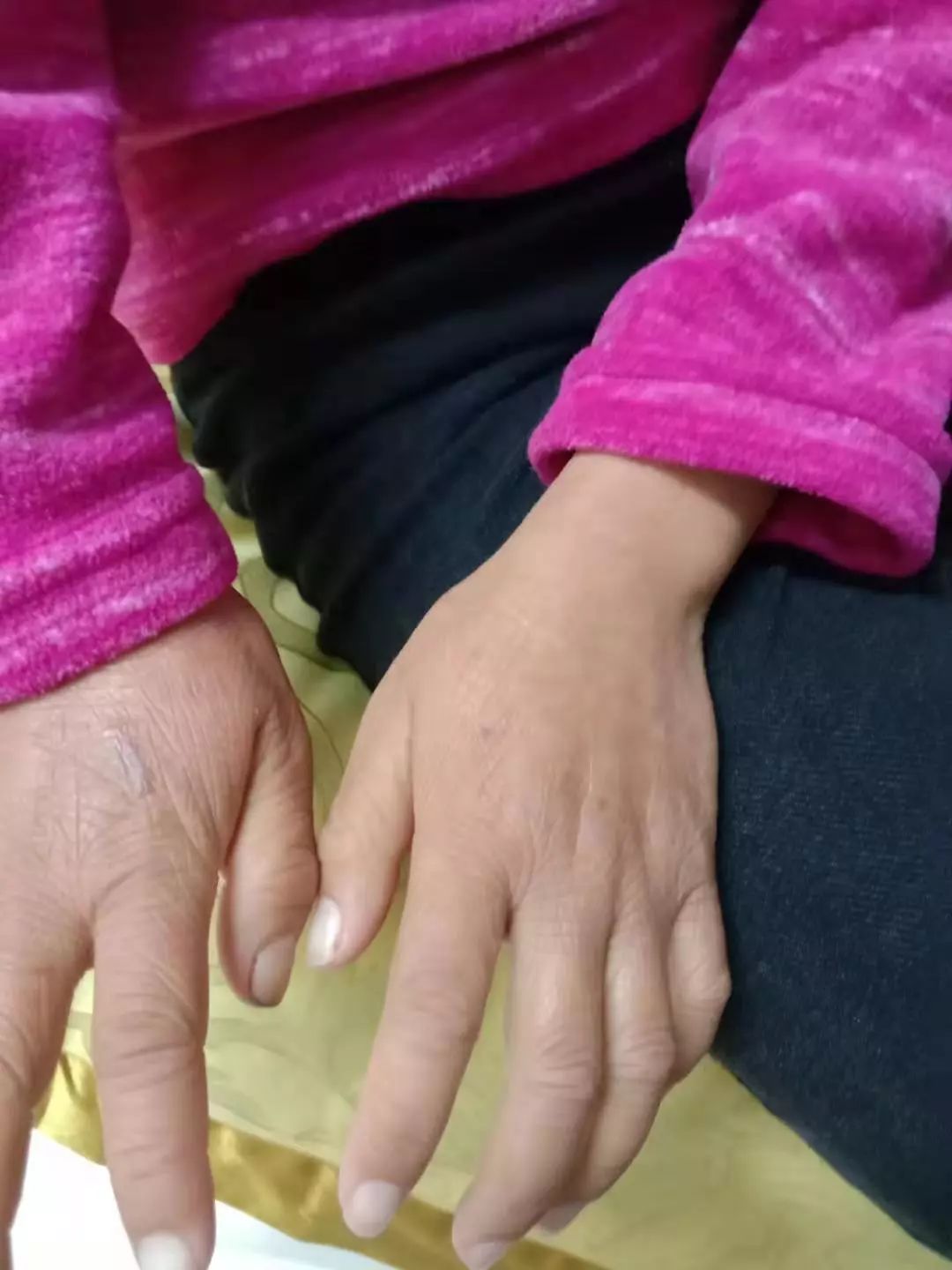 扶贫帮困情永在——期待“鱼鳞女孩”的蜕变重生