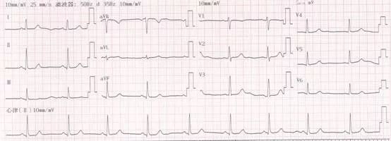 专栏丨贾卫滨：心电图“掉头”现象的定义与诊断特征（1）