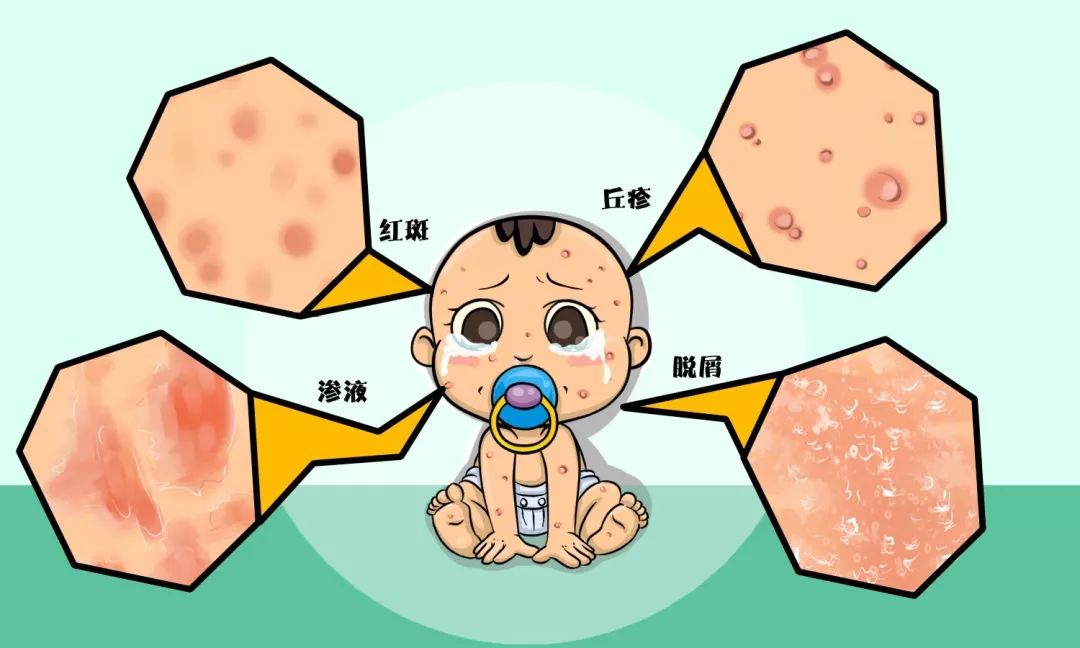 宝宝湿疹反反复复用什么药比较好,宝宝湿疹反复到底该不该涂保湿霜