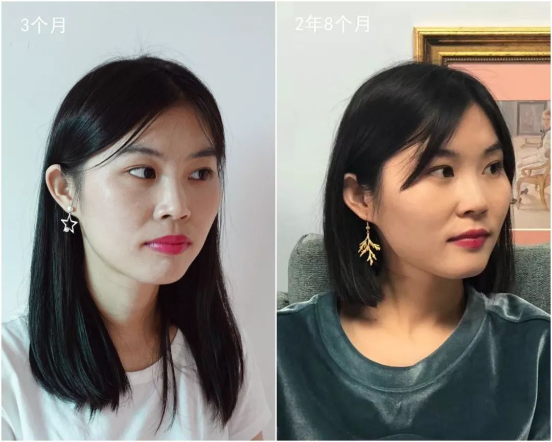 戴牙套改变了脸型可以恢复吗,戴牙套改变颜值