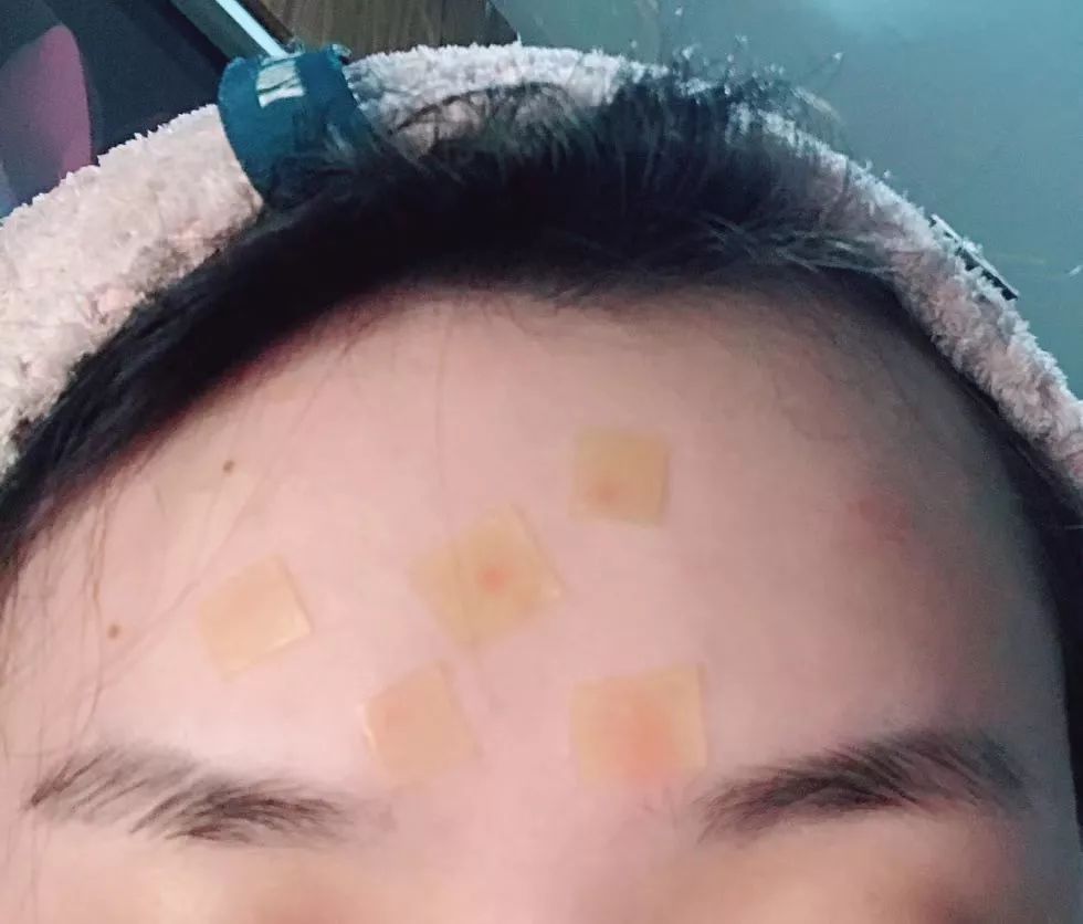 战痘总结,战痘十年是什么样子