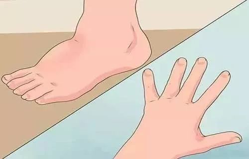 一文读懂：水肿