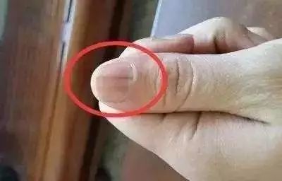 科普|指甲的状态反映了你身体的状况