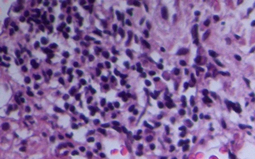 alp和ggt偏高是什么意思,alp和ggt下降意味着什么