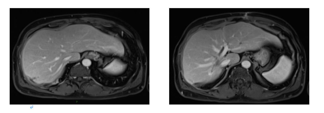 升结肠癌肝转移，如何实现治愈“神话”？|病例分享