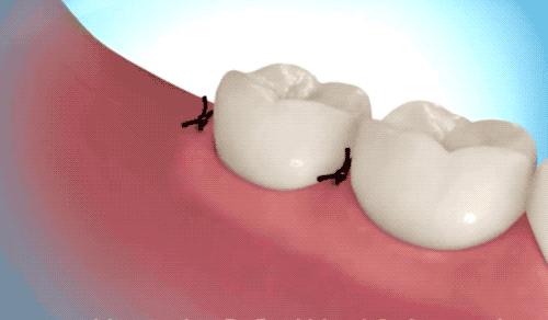 拔智齿的全过程科普,拔智齿细致操作过程