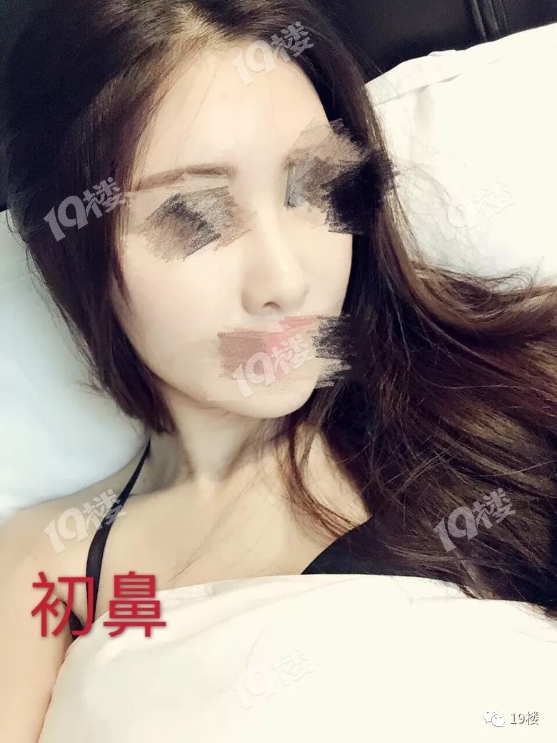 美丽女子整容失败,鼻整形失败多久可以修复