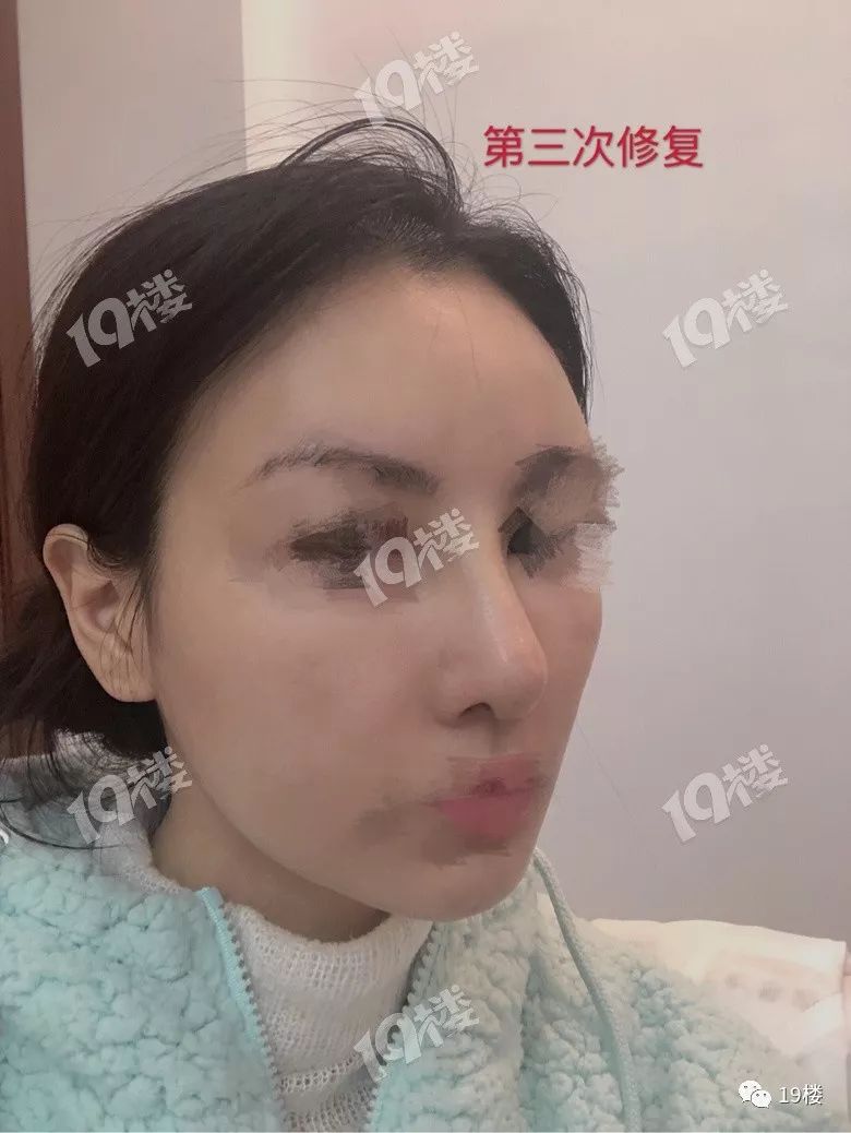美丽女子整容失败,鼻整形失败多久可以修复