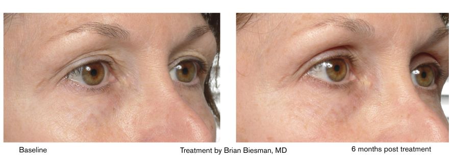 热玛吉抗衰老手术适应6类人群,了解热玛吉抗衰老看这篇就够了