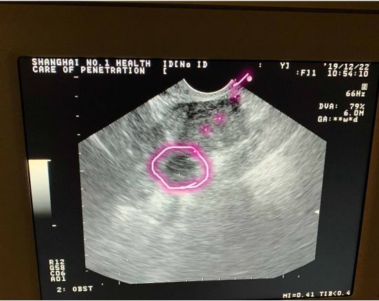 取卵后多久出院,取卵手术有多疼