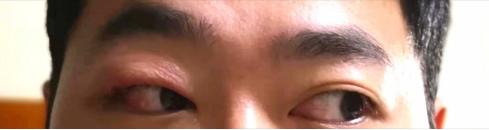 肖战麦粒肿上热搜！什么，眼皮红肿热痛就是麦粒肿？麦粒肿：这个锅我不背