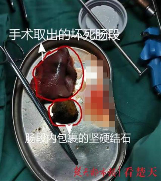 鸡蛋大硬石头“溜”进肠道，八旬老人“堵得慌”