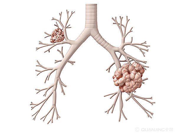 抗癌专家谈抗癌,肺鳞状细胞癌死亡率高吗
