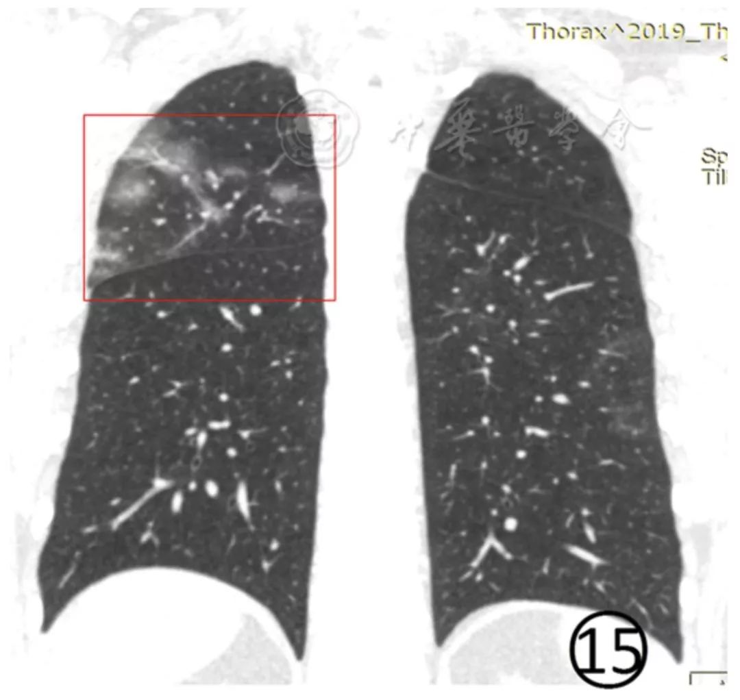 新冠肺炎影像演变过程,新冠肺炎胸部影像学特点有哪些