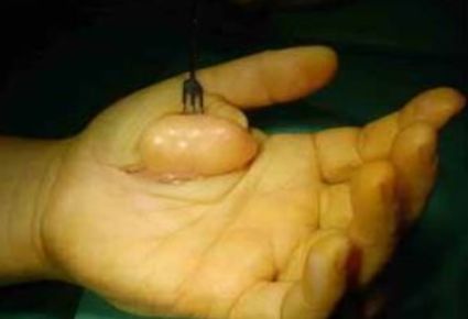 最新治疗恶性肿瘤药,12种抗肿瘤新药目录