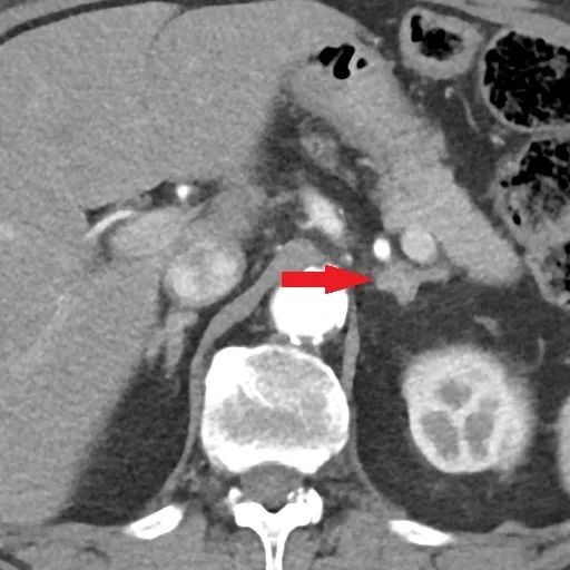 在线心内会诊室丨原醛治疗,“柳暗花明又一村”