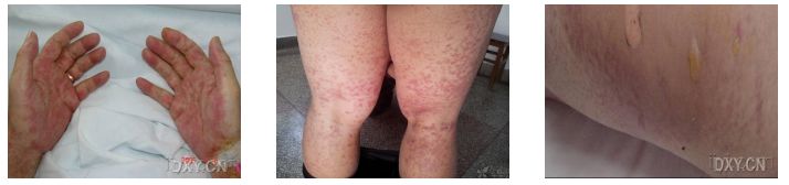 gvhd是什么疾病,gvhd并发症临床表现