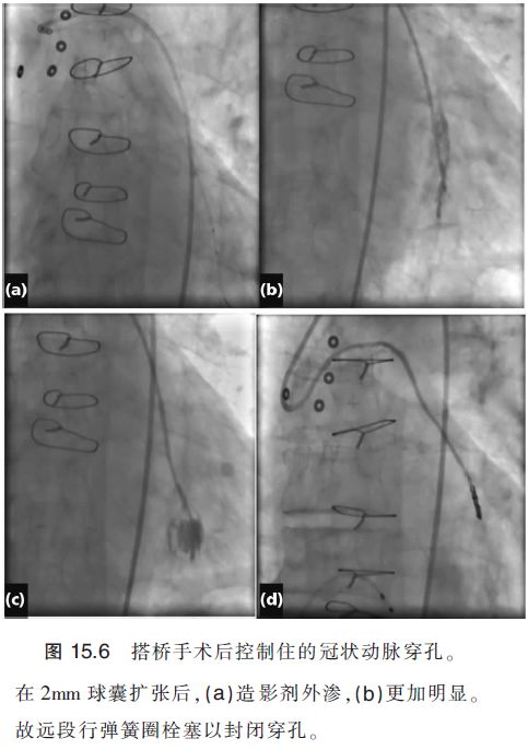 介入引起的血管并发症,介入栓塞治疗的并发症
