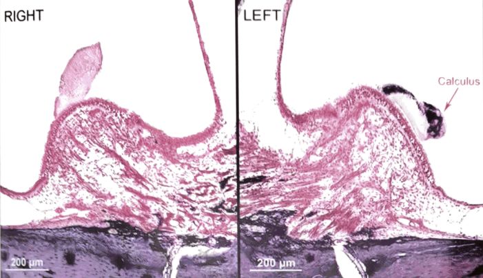 梅尼埃病深度解析,梅尼埃病病理解剖