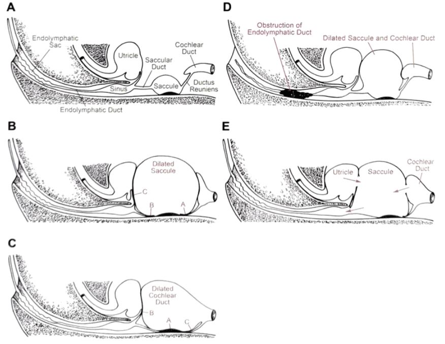 梅尼埃病深度解析,梅尼埃病病理解剖