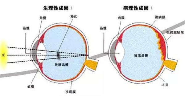 高度近视飞蚊症动手术,三十岁高度近视飞蚊症