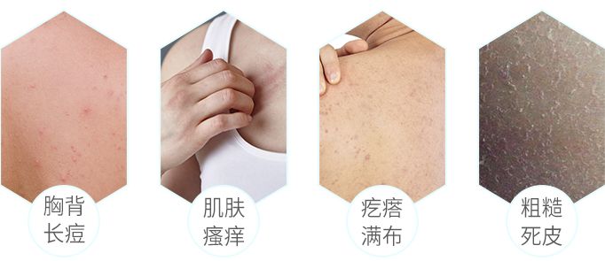 前胸鸡皮痘痘怎么处理,胸背痘痘清理