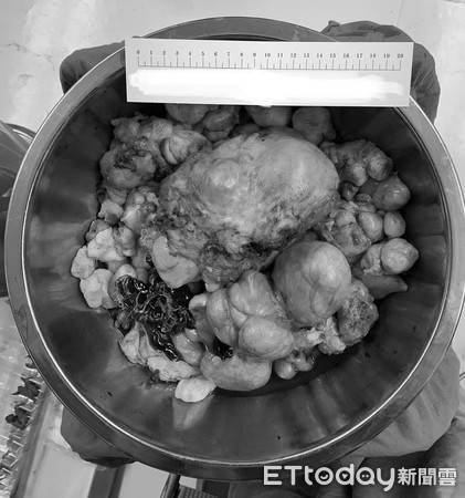 女医生做手术突然大出血,女医生做手术后大出血