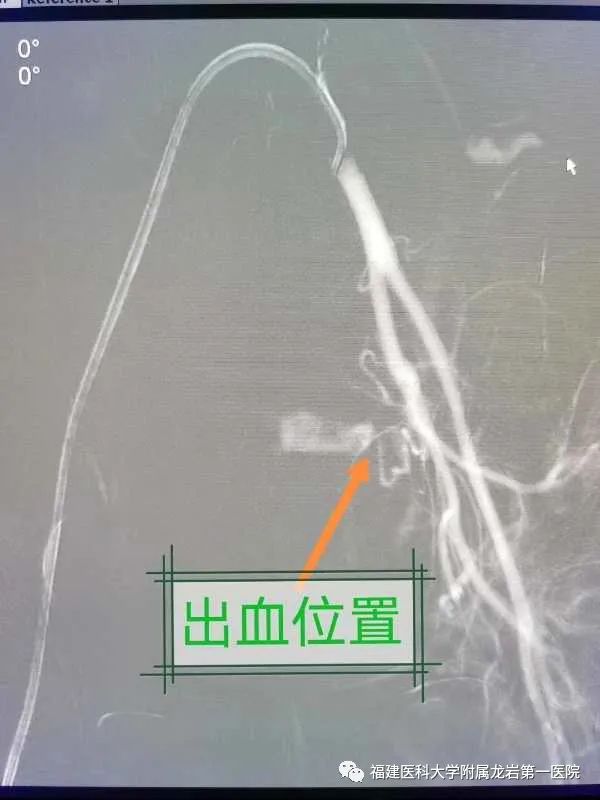 顺产6斤女宝宝生产过程痛不欲生,生完宝宝后大出血