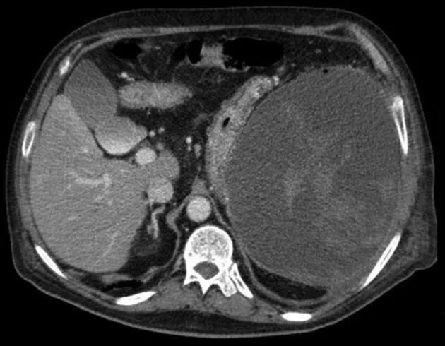病例丨急性心梗后脾出血，竟是抗栓惹的祸？