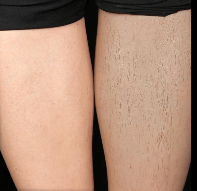 光滑无暇|黑丑的“毛裤腿”，用它，10分钟“脱”得一干二净，肌肤光滑细腻