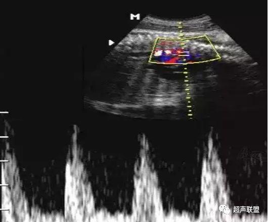 胎儿宫内窘迫通过什么检查出来的,胎儿宫内缺氧的超声视频