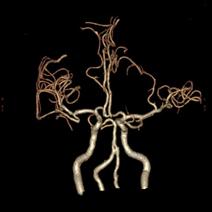 左侧大脑后动脉开窗畸形图片,脑部基底动脉开窗畸形如何治疗