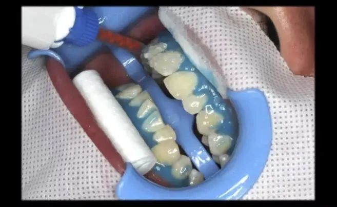 牙科医生教你牙齿美白,牙齿黄渍刷不干净老牙医教你一招