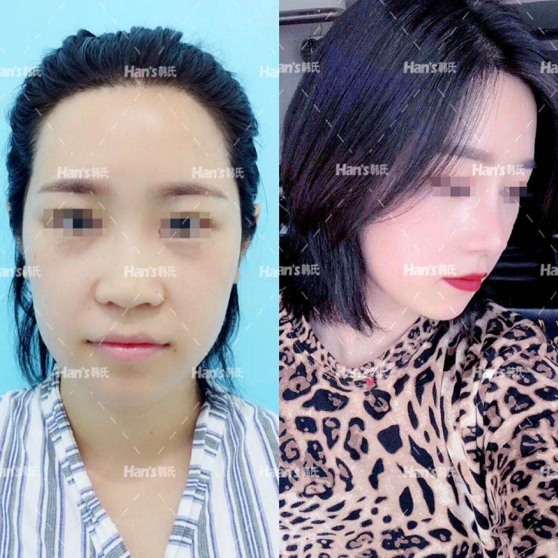 隆鼻后鼻尖发红多久可以恢复正常,隆鼻做了一年了鼻尖发红怎么回事