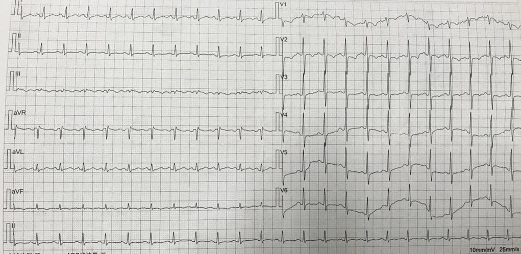 心脏重构用什么药物,改善心脏重构的药