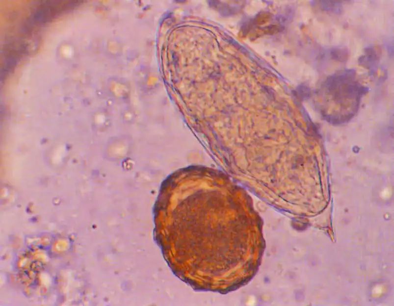 尿液有形成分检查,尿液中检测到的有形成分有哪些