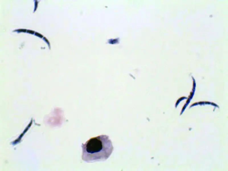 尿液中有肉眼可见杂质正常吗,尿液有形成分检查细菌偏高