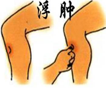 下肢总有水肿怎么回事?名中医王清海教授教你消掉水肿